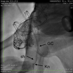 Fractured guiding catheter (black arrow) inside the 8F sheath (small black arrow). GC: guiding catheter; Kn: knot; Sh: sheath.
