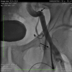 Angiogram of femoral artery with small leak (black arrow) and tortuous iliac artery (small black arrow).