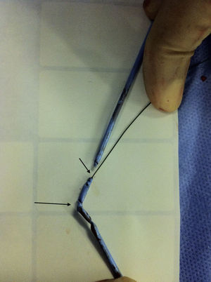 Fractured guiding catheter (black arrow) with multiple knots and with the wire inside (small black arrow).