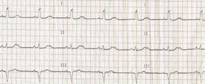 ECG revelando BAV 2.° grau 2:1 com BCRE.