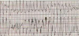 Torsade de pointes.