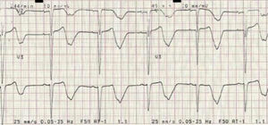 BAV 2:1 (FC de ± 45 bpm) com alargamento do intervalo QTc (± 690 ms).