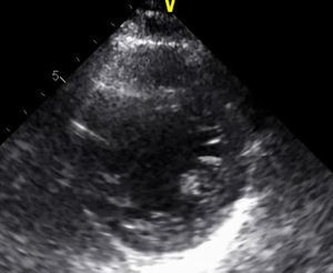 Ecocardiograma: eixo curto paraesternal revelando imagens compatíveis com VENC a nível apical.