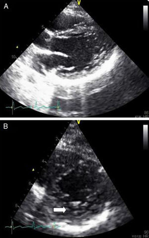 (A e B) – Ecocardiograma dos filhos da paciente revelando imagens compatíveis com VENC.
