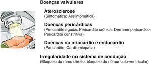Toxicidade cardiovascular associada à radioterapia.