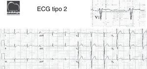 ECG mostra alteração ST-T em V1 (elevação ponto J e supra ST-T em «sela»).