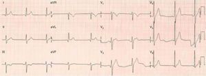 ECG revelando elevação do ponto J em V1 com ST em rampa descendente e elevação, em rampa horizontal, do segmento ST em V2.