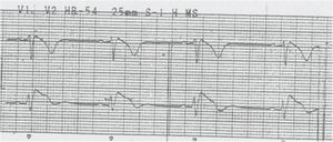 ECG com padrão de Brugada tipo 1.