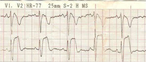 ECG com padrão de Brugada no contexto de uma infeção respiratória.