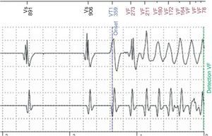 Traçado de Home Monitoring documentando o início de fibrilação ventricular.