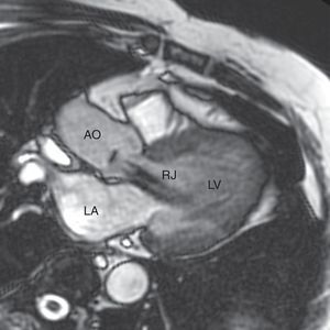 LVOT MRI image showing a severe regurgitant jet in the aortic valve with regurgitant fraction of 84%. AO: aorta; LA: left atrium; LV: left ventricle; RJ: regurgitant jet.