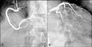 Cine coronary angiography images showing absence of obstructive lesions in the right (A) and left (B) coronary arteries.