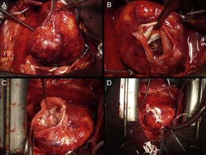 (A) Surgical view of large aneurysm of the left ventricular posterolateral wall. (B) Neck of left ventricular aneurysm. The fibrous wall of the aneurysm, the endocardium and the papillary muscles of the mitral valve can be seen. (C) Exclusion of the aneurysm using a bovine pericardial patch sutured to the edges of the myocardium. (D) Occlusion and reinforcement of sutures with Teflon bands.