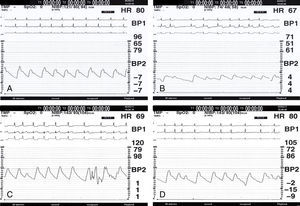 Electrocardiogram and invasive blood pressure (BP) records during percutaneous mitral valvuloplasty (PMV). (A) Isoelectric ST segment and normal BP before performing PMV; (B) after last balloon inflation to 30mm, a new ST-segment elevation in lead II accompanied by significant BP drop is recorded; (C) intravenous phenylephrine was required to normalize BP, but the ST segment remained elevated so coronary angiography was performed at this time; (D) the condition resolved spontaneously in a few minutes, the ST segment and BP returning to baseline levels.