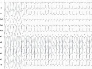 Twelve-lead ECG. In the first part of the tracing a broad QRS tachycardia is shown, with LBBB inferior axis morphology and negative QRS complex in aVL. After this run there is a change to a narrow QRS complex. Surface leads (I, II, III, aVF, V1 and V6), and electrograms recorded from the right ventricular apex and the coronary sinus.
