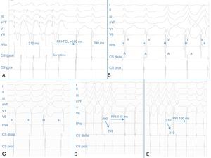 (A): The long postpacing interval (PPI-TCL>180ms) after tachycardia entrainment from the right ventricular apex and the tachycardia cycle length are shown; (B): intracardiac recordings during the tachycardia. The first two beats correspond to an AVNRT, and the last three to the ventricular tachycardia. Note the absence of His bundle deflection and variable retrograde conduction during the runs of broad complexes; (C): absence of atrial advancement by spontaneous extrastimulus when the His bundle was refractory; (D and E): transient entrainment of the AVNRT by the spontaneous non-sustained ventricular tachycardia is observed, at different cycle lengths (290 and 310ms respectively). The long interval after the last beat of the broad QRS complex tachycardia and the first beat of the narrow QRS complex tachycardia can also be seen, with VAV response and a fixed VA interval after the ventricular tachycardia (see text).