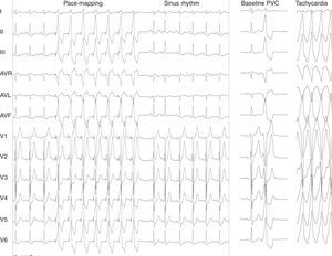 Left: result of pace-mapping; right: baseline PVC and spontaneous ventricular tachycardia.