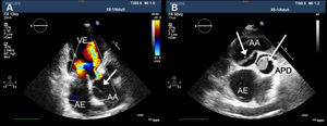 Ecocardiograma transtorácico que mostrou (A) regurgitação aórtica moderada, raiz da aorta dilatada e flap da íntima com sinal de duplo lúmen (seta curta); (B) visualizou-se também trombo na artéria pulmonar direita (seta longa). AA: aorta ascendente; AE: aurícula esquerda; APD: artéria pulmonar direita; VE: ventrículo esquerdo.
