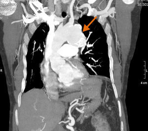 Angio-TC torácico, revelando um volumoso aneurisma saculiforme com origem na aorta torácica descendente, distal à emergência da artéria subclávia esquerda.