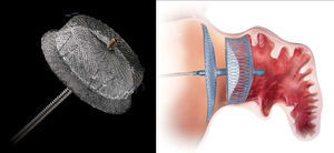 Dispositivo ACP (St. Jude Medical, Plymouth, Minnesota, Estados Unidos). A imagem do ACP foi cedida e é propriedade da St. Jude Medical, Plymouth, Minnesota, Estados Unidos.