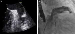 Avaliação do AAE previamente à implantação do dispositivo de encerramento, por ETE (A, em plano medioesofágico aos 95°) e por fluoroscopia com contraste (B, em incidência oblíqua anterior direita).