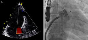 Avaliação do encerramento do AAE após posicionamento do dispositivo, por ETE com Doppler cor (A, em plano medioesofágico aos 42°) e por fluoroscopia com contraste (B, em incidência ântero-posterior).