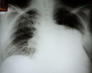 A radiografia do tórax evidencia imagem radiopaca em base e terço médio de hemitórax esquerdo, com bordos calcificados. O parênquima pulmonar apresenta área de oligoemia em terço superior esquerdo e infiltrado intersticial à direita.