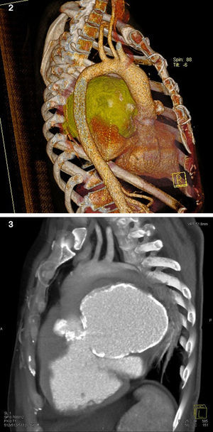 Angiotomografia do tórax mostrando pseudoaneurisma da via de saída do ventrículo esquerdo.