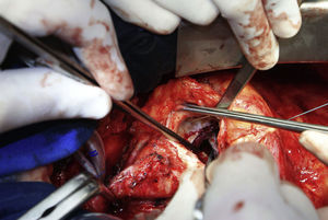 Orifício de comunicação do pseudoaneurisma com o ventrículo esquerdo visualizado após retirada da prótese aórtica.