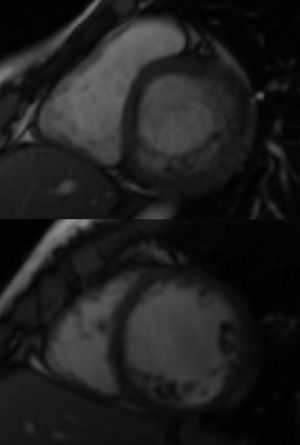 Cardiac magnetic resonance images suggesting left ventricular noncompaction.