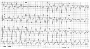 Clinical ventricular tachycardia (LBB block pattern, superior axis).
