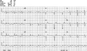 Baseline ECG: sinus rhythm, intraventricular conduction defects and significant PR prolongation.