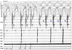 Inducible sustained VT with LBB block pattern and superior axis and a clear right bundle branch deflection (arrows) preceding each ventricular complex, suggesting the RBB is part of the circuit.
