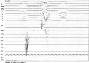 Intracardiac electrogram revealing significant HV interval prolongation (100 ms).