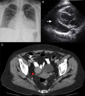 A: Anteroposterior chest X-ray showing mild bilateral pleural effusion and massive bottle-shaped heart manifesting severe cardiomegaly; B: Two-dimensional echocardiography showing a 3-cm global pericardial effusion (arrow) and signs of cardiac tamponade; C: Pelvic computed tomography showing a right ovarian tumor, a fibroma (arrow).