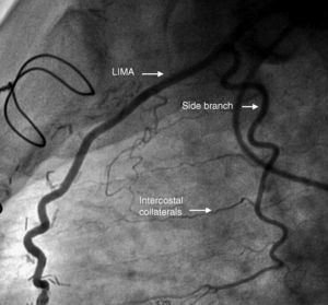 A large side branch originating from the left internal mammary artery. LIMA: left internal mammary artery.