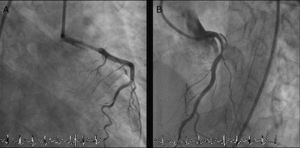 Coronary angiography showing extensive left main coronary artery dissection. The left circumflex artery is not visualized. (A): Right anterior oblique with caudal angulation; (B): left anterior oblique with cranial angulation.