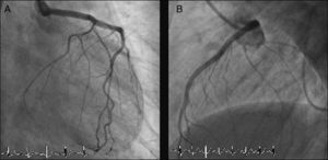 Coronary angiography after left main coronary artery stenting. Both the left anterior descending artery and left circumflex artery are visualized and present no angiographic lesions. (A): Right anterior oblique with caudal angulation; (B): left lateral.