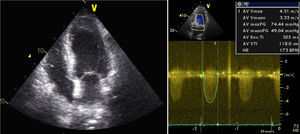 Ecocardiograma transtorácico: ventrículo esquerdo não dilatado, com ligeira hipertrofia do septo interventricular, com boa função sistólica global; gradiente transvalvular aórtico máximo de 74 e médio de 49mmHg.