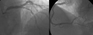 Coronariografia: doença coronária de 2 vasos: lesão de 75% no segmento médio da descendente anterior e lesão de 90% na origem da descendente posterior.