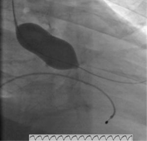 Valvuloplastia aórtica com balão NUCLEUS 20mm, sob ritmo de pacing a 220 bpm.