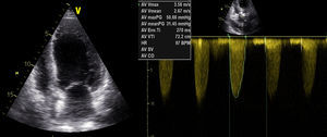 Ecocardiograma transtorácico: ventrículo esquerdo com compromisso moderado a grave da função sistólica global; gradiente transvalvular aórtico médio de 31mmHg.