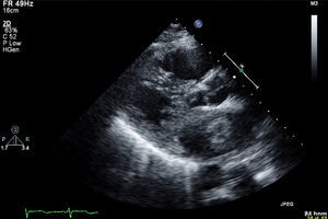 Imagem de ecocardiografia bidimensional, para-esternal eixo longo. Pode observar-se uma estrutura na aurícula esquerda, de contornos definidos, apensa ao septo interauricular.