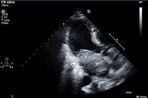 Imagem de ecocardiografia bidimensional, apical de 3 câmaras. Mesma estrutura de dimensões aproximadas de 5,4 × 3,2cm, com protusão em diástole para o ventrículo esquerdo.