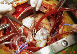 Imagem fotográfica obtida durante o procedimento cirúrgico.