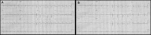 Electrocardiography at presentation with diffuse T-wave inversion (A) and after recurrent chest pain with transient ST-segment elevation in inferior leads (B).