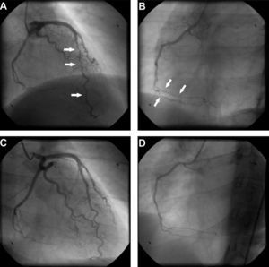 Coronary angiography at presentation showing diffuse vessel wall irregularities in the left anterior descending artery (A) and right coronary artery (B). Coronary angiography after one year of immunosuppressive therapy showing resolution of vasculopathy in the anterior descending artery (C) and right coronary artery (D).