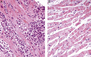 Hematoxylin and eosin cardiac biopsy specimen at presentation showing eosinophilic infiltration (A). Myocardial biopsy, after glucocorticoid and immunosuppressive therapy, showing complete resolution of eosinophilic myocarditis (B).