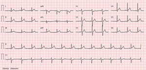 Electrocardiogram on day of chest pain onset: sinus rhythm and slight ST-segment elevation with upward concavity in leads I, II, III, aVF and V3–V6.