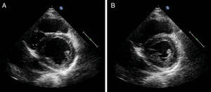 Echocardiogram in parasternal short-axis view showing moderately depressed left ventricular systolic function (ejection fraction of 38%), with global hypocontractility, although more obvious in the posterior, inferior and lateral walls (A – diastole; B – systole).